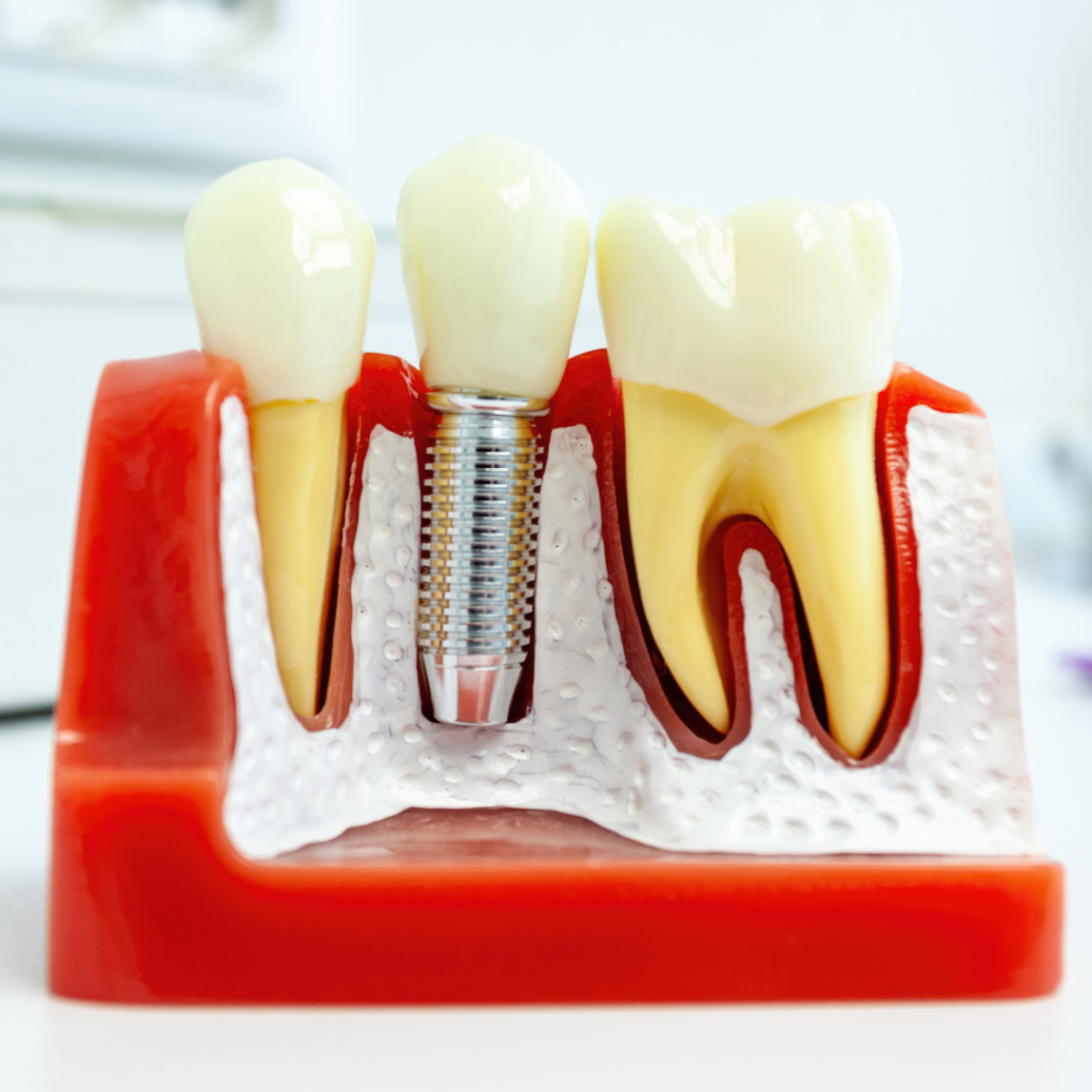 implant tedavisi