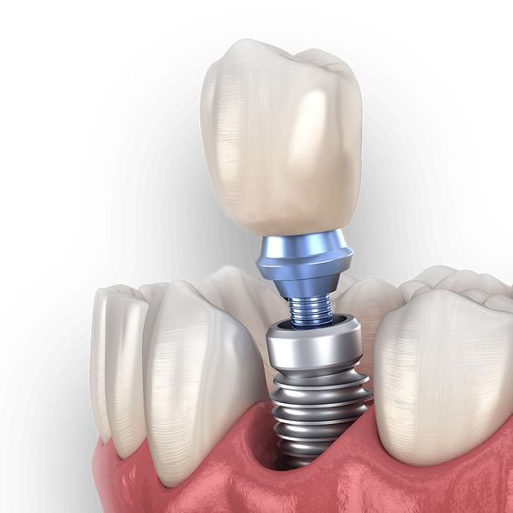 çapa implant, çapa diş implantı, çapa implant tedavisi, çapa implant diş, çapa implant fiyatları, çapa diş implant fiyatları, fatih implant, fatih diş implantı, fatih implant tedavisi, fatih implant fiyatları, fındıkzade implant, fındıkzade diş implantı, fındıkzade implant tedavisi, fındıkzade implant fiyatları, aksaray implant, aksaray diş implantı, aksaray implant tedavisi, aksaray implant fiyatları, şehremini implant, şehremini diş implantı, şehremini implant tedavisi, şehremini implant fiyatları, kocamustafapaşa implant, kocamustafapaşa implant tedavisi, kocamustafapaşa implant fiyatları, cerrahpaşa implant, cerrahpaşa diş implantı, cerrahpaşa implant tedavisi, cerrahpaşa implant fiyatları, haseki implant, haseki implant tedavisi, haseki implant fiyatları, laleli implant, laleli implant tedavisi, laleli implant fiyatları, beyazıt implant, beyazıt implant tedavisi, beyazıt implant fiyatları, eminönü implant, eminönü implant tedavisi, eminönü implant fiyatları, sirkeci implant, sirkeci implant tedavisi, sirkeci implant fiyatları, sultanahmet implant, sultanahmet implant tedavisi, sultanahmet implant fiyatları, balat implant, balat implant tedavisi, balat implant fiyatları, fener implant, fener implant tedavisi, fener implant fiyatları, karagümrük implant, karagümrük implant tedavisi, karagümrük implant fiyatları, edirnekapı implant, edirnekapı implant tedavisi, edirnekapı implant fiyatları, akşemsettin implant, akşemsettin implant tedavisi, akşemsettin implant fiyatları, kıztaşı implant, kıztaşı implant tedavisi, kıztaşı implant fiyatları, horhor implant, horhor implant tedavisi, horhor implant fiyatları, vezneciler implant, vezneciler implant tedavisi, vezneciler implant fiyatları, yenikapı implant, yenikapı implant tedavisi, yenikapı implant fiyatları, samatya implant, samatya implant tedavisi, samatya implant fiyatları, yedikule implant, yedikule implant tedavisi, yedikule implant fiyatları, ayvansaray implant, ayvansaray implant tedavisi, ayvansaray implant fiyatları