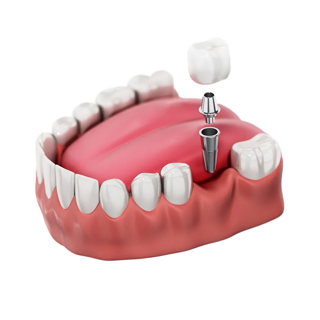 fatih implant, fatih diş implantı, fatih implant tedavisi, fatih implant diş, fatih implant fiyatları, fatih diş implant fiyatları, fındıkzade implant, fındıkzade diş implantı, fındıkzade implant tedavisi, fındıkzade implant diş, fındıkzade implant fiyatları, fındıkzade diş implant fiyatları, aksaray implant, aksaray diş implantı, aksaray implant tedavisi, aksaray implant diş, aksaray implant fiyatları, aksaray diş implant fiyatları, çapa implant, çapa diş implantı, çapa implant tedavisi, çapa implant diş, çapa implant fiyatları, çapa diş implant fiyatları, şehremini implant, şehremini diş implantı, şehremini implant tedavisi, şehremini implant diş, şehremini implant fiyatları, şehremini diş implant fiyatları, kocamustafapaşa implant, kocamustafapaşa diş implantı, kocamustafapaşa implant tedavisi, kocamustafapaşa implant diş, kocamustafapaşa implant fiyatları, kocamustafapaşa diş implant fiyatları, cerrahpaşa implant, cerrahpaşa diş implantı, cerrahpaşa implant tedavisi, cerrahpaşa implant diş, cerrahpaşa implant fiyatları, cerrahpaşa diş implant fiyatları, haseki implant, haseki diş implantı, haseki implant tedavisi, haseki implant diş, haseki implant fiyatları, haseki diş implant fiyatları, laleli implant, laleli diş implantı, laleli implant tedavisi, laleli implant diş, laleli implant fiyatları, laleli diş implant fiyatları, beyazıt implant, beyazıt diş implantı, beyazıt implant tedavisi, beyazıt implant diş, beyazıt implant fiyatları, beyazıt diş implant fiyatları, eminönü implant, eminönü diş implantı, eminönü implant tedavisi, eminönü implant diş, eminönü implant fiyatları, eminönü diş implant fiyatları, sirkeci implant, sirkeci diş implantı, sirkeci implant tedavisi, sirkeci implant diş, sirkeci implant fiyatları, sirkeci diş implant fiyatları, sultanahmet implant, sultanahmet diş implantı, sultanahmet implant tedavisi, sultanahmet implant diş, sultanahmet implant fiyatları, sultanahmet diş implant fiyatları, balat implant, balat diş implantı, balat implant tedavisi, balat implant diş, balat implant fiyatları, balat diş implant fiyatları, fener implant, fener diş implantı, fener implant tedavisi, fener implant diş, fener implant fiyatları, fener diş implant fiyatları, karagümrük implant, karagümrük diş implantı, karagümrük implant tedavisi, karagümrük implant diş, karagümrük implant fiyatları, karagümrük diş implant fiyatları, edirnekapı implant, edirnekapı diş implantı, edirnekapı implant tedavisi, edirnekapı implant diş, edirnekapı implant fiyatları, edirnekapı diş implant fiyatları, akşemsettin implant, akşemsettin diş implantı, akşemsettin implant tedavisi, akşemsettin implant diş, akşemsettin implant fiyatları, akşemsettin diş implant fiyatları, kıztaşı implant, kıztaşı diş implantı, kıztaşı implant tedavisi, kıztaşı implant diş, kıztaşı implant fiyatları, kıztaşı diş implant fiyatları, horhor implant, horhor diş implantı, horhor implant tedavisi, horhor implant diş, horhor implant fiyatları, horhor diş implant fiyatları, vezneciler implant, vezneciler diş implantı, vezneciler implant tedavisi, vezneciler implant diş, vezneciler implant fiyatları, vezneciler diş implant fiyatları, yenikapı implant, yenikapı diş implantı, yenikapı implant tedavisi, yenikapı implant diş, yenikapı implant fiyatları, yenikapı diş implant fiyatları, samatya implant, samatya diş implantı, samatya implant tedavisi, samatya implant diş, samatya implant fiyatları, samatya diş implant fiyatları, yedikule implant, yedikule diş implantı, yedikule implant tedavisi, yedikule implant diş, yedikule implant fiyatları, yedikule diş implant fiyatları, ayvansaray implant, ayvansaray diş implantı, ayvansaray implant tedavisi, ayvansaray implant diş, ayvansaray implant fiyatları, ayvansaray diş implant fiyatları
