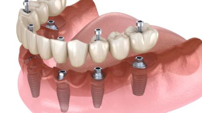 çapa implant, çapa diş implantı, çapa implant tedavisi, çapa implant diş, çapa implant fiyatları, çapa diş implant fiyatları, fatih implant, fatih diş implantı, fatih implant tedavisi, fatih implant fiyatları, fındıkzade implant, fındıkzade diş implantı, fındıkzade implant tedavisi, fındıkzade implant fiyatları, aksaray implant, aksaray diş implantı, aksaray implant tedavisi, aksaray implant fiyatları, şehremini implant, şehremini diş implantı, şehremini implant tedavisi, şehremini implant fiyatları, kocamustafapaşa implant, kocamustafapaşa implant tedavisi, kocamustafapaşa implant fiyatları, cerrahpaşa implant, cerrahpaşa diş implantı, cerrahpaşa implant tedavisi, cerrahpaşa implant fiyatları, haseki implant, haseki implant tedavisi, haseki implant fiyatları, laleli implant, laleli implant tedavisi, laleli implant fiyatları, beyazıt implant, beyazıt implant tedavisi, beyazıt implant fiyatları, eminönü implant, eminönü implant tedavisi, eminönü implant fiyatları, sirkeci implant, sirkeci implant tedavisi, sirkeci implant fiyatları, sultanahmet implant, sultanahmet implant tedavisi, sultanahmet implant fiyatları, balat implant, balat implant tedavisi, balat implant fiyatları, fener implant, fener implant tedavisi, fener implant fiyatları, karagümrük implant, karagümrük implant tedavisi, karagümrük implant fiyatları, edirnekapı implant, edirnekapı implant tedavisi, edirnekapı implant fiyatları, akşemsettin implant, akşemsettin implant tedavisi, akşemsettin implant fiyatları, kıztaşı implant, kıztaşı implant tedavisi, kıztaşı implant fiyatları, horhor implant, horhor implant tedavisi, horhor implant fiyatları, vezneciler implant, vezneciler implant tedavisi, vezneciler implant fiyatları, yenikapı implant, yenikapı implant tedavisi, yenikapı implant fiyatları, samatya implant, samatya implant tedavisi, samatya implant fiyatları, yedikule implant, yedikule implant tedavisi, yedikule implant fiyatları, ayvansaray implant, ayvansaray implant tedavisi, ayvansaray implant fiyatları