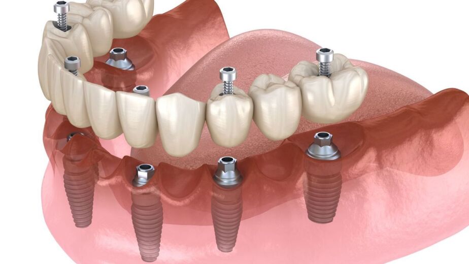çapa implant, çapa diş implantı, çapa implant tedavisi, çapa implant diş, çapa implant fiyatları, çapa diş implant fiyatları, fatih implant, fatih diş implantı, fatih implant tedavisi, fatih implant fiyatları, fındıkzade implant, fındıkzade diş implantı, fındıkzade implant tedavisi, fındıkzade implant fiyatları, aksaray implant, aksaray diş implantı, aksaray implant tedavisi, aksaray implant fiyatları, şehremini implant, şehremini diş implantı, şehremini implant tedavisi, şehremini implant fiyatları, kocamustafapaşa implant, kocamustafapaşa implant tedavisi, kocamustafapaşa implant fiyatları, cerrahpaşa implant, cerrahpaşa diş implantı, cerrahpaşa implant tedavisi, cerrahpaşa implant fiyatları, haseki implant, haseki implant tedavisi, haseki implant fiyatları, laleli implant, laleli implant tedavisi, laleli implant fiyatları, beyazıt implant, beyazıt implant tedavisi, beyazıt implant fiyatları, eminönü implant, eminönü implant tedavisi, eminönü implant fiyatları, sirkeci implant, sirkeci implant tedavisi, sirkeci implant fiyatları, sultanahmet implant, sultanahmet implant tedavisi, sultanahmet implant fiyatları, balat implant, balat implant tedavisi, balat implant fiyatları, fener implant, fener implant tedavisi, fener implant fiyatları, karagümrük implant, karagümrük implant tedavisi, karagümrük implant fiyatları, edirnekapı implant, edirnekapı implant tedavisi, edirnekapı implant fiyatları, akşemsettin implant, akşemsettin implant tedavisi, akşemsettin implant fiyatları, kıztaşı implant, kıztaşı implant tedavisi, kıztaşı implant fiyatları, horhor implant, horhor implant tedavisi, horhor implant fiyatları, vezneciler implant, vezneciler implant tedavisi, vezneciler implant fiyatları, yenikapı implant, yenikapı implant tedavisi, yenikapı implant fiyatları, samatya implant, samatya implant tedavisi, samatya implant fiyatları, yedikule implant, yedikule implant tedavisi, yedikule implant fiyatları, ayvansaray implant, ayvansaray implant tedavisi, ayvansaray implant fiyatları