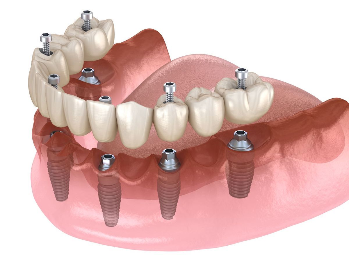 çapa implant, çapa diş implantı, çapa implant tedavisi, çapa implant diş, çapa implant fiyatları, çapa diş implant fiyatları, fatih implant, fatih diş implantı, fatih implant tedavisi, fatih implant fiyatları, fındıkzade implant, fındıkzade diş implantı, fındıkzade implant tedavisi, fındıkzade implant fiyatları, aksaray implant, aksaray diş implantı, aksaray implant tedavisi, aksaray implant fiyatları, şehremini implant, şehremini diş implantı, şehremini implant tedavisi, şehremini implant fiyatları, kocamustafapaşa implant, kocamustafapaşa implant tedavisi, kocamustafapaşa implant fiyatları, cerrahpaşa implant, cerrahpaşa diş implantı, cerrahpaşa implant tedavisi, cerrahpaşa implant fiyatları, haseki implant, haseki implant tedavisi, haseki implant fiyatları, laleli implant, laleli implant tedavisi, laleli implant fiyatları, beyazıt implant, beyazıt implant tedavisi, beyazıt implant fiyatları, eminönü implant, eminönü implant tedavisi, eminönü implant fiyatları, sirkeci implant, sirkeci implant tedavisi, sirkeci implant fiyatları, sultanahmet implant, sultanahmet implant tedavisi, sultanahmet implant fiyatları, balat implant, balat implant tedavisi, balat implant fiyatları, fener implant, fener implant tedavisi, fener implant fiyatları, karagümrük implant, karagümrük implant tedavisi, karagümrük implant fiyatları, edirnekapı implant, edirnekapı implant tedavisi, edirnekapı implant fiyatları, akşemsettin implant, akşemsettin implant tedavisi, akşemsettin implant fiyatları, kıztaşı implant, kıztaşı implant tedavisi, kıztaşı implant fiyatları, horhor implant, horhor implant tedavisi, horhor implant fiyatları, vezneciler implant, vezneciler implant tedavisi, vezneciler implant fiyatları, yenikapı implant, yenikapı implant tedavisi, yenikapı implant fiyatları, samatya implant, samatya implant tedavisi, samatya implant fiyatları, yedikule implant, yedikule implant tedavisi, yedikule implant fiyatları, ayvansaray implant, ayvansaray implant tedavisi, ayvansaray implant fiyatları
