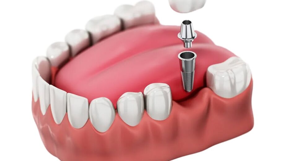 fatih implant, fatih diş implantı, fatih implant tedavisi, fatih implant diş, fatih implant fiyatları, fatih diş implant fiyatları, fındıkzade implant, fındıkzade diş implantı, fındıkzade implant tedavisi, fındıkzade implant diş, fındıkzade implant fiyatları, fındıkzade diş implant fiyatları, aksaray implant, aksaray diş implantı, aksaray implant tedavisi, aksaray implant diş, aksaray implant fiyatları, aksaray diş implant fiyatları, çapa implant, çapa diş implantı, çapa implant tedavisi, çapa implant diş, çapa implant fiyatları, çapa diş implant fiyatları, şehremini implant, şehremini diş implantı, şehremini implant tedavisi, şehremini implant diş, şehremini implant fiyatları, şehremini diş implant fiyatları, kocamustafapaşa implant, kocamustafapaşa diş implantı, kocamustafapaşa implant tedavisi, kocamustafapaşa implant diş, kocamustafapaşa implant fiyatları, kocamustafapaşa diş implant fiyatları, cerrahpaşa implant, cerrahpaşa diş implantı, cerrahpaşa implant tedavisi, cerrahpaşa implant diş, cerrahpaşa implant fiyatları, cerrahpaşa diş implant fiyatları, haseki implant, haseki diş implantı, haseki implant tedavisi, haseki implant diş, haseki implant fiyatları, haseki diş implant fiyatları, laleli implant, laleli diş implantı, laleli implant tedavisi, laleli implant diş, laleli implant fiyatları, laleli diş implant fiyatları, beyazıt implant, beyazıt diş implantı, beyazıt implant tedavisi, beyazıt implant diş, beyazıt implant fiyatları, beyazıt diş implant fiyatları, eminönü implant, eminönü diş implantı, eminönü implant tedavisi, eminönü implant diş, eminönü implant fiyatları, eminönü diş implant fiyatları, sirkeci implant, sirkeci diş implantı, sirkeci implant tedavisi, sirkeci implant diş, sirkeci implant fiyatları, sirkeci diş implant fiyatları, sultanahmet implant, sultanahmet diş implantı, sultanahmet implant tedavisi, sultanahmet implant diş, sultanahmet implant fiyatları, sultanahmet diş implant fiyatları, balat implant, balat diş implantı, balat implant tedavisi, balat implant diş, balat implant fiyatları, balat diş implant fiyatları, fener implant, fener diş implantı, fener implant tedavisi, fener implant diş, fener implant fiyatları, fener diş implant fiyatları, karagümrük implant, karagümrük diş implantı, karagümrük implant tedavisi, karagümrük implant diş, karagümrük implant fiyatları, karagümrük diş implant fiyatları, edirnekapı implant, edirnekapı diş implantı, edirnekapı implant tedavisi, edirnekapı implant diş, edirnekapı implant fiyatları, edirnekapı diş implant fiyatları, akşemsettin implant, akşemsettin diş implantı, akşemsettin implant tedavisi, akşemsettin implant diş, akşemsettin implant fiyatları, akşemsettin diş implant fiyatları, kıztaşı implant, kıztaşı diş implantı, kıztaşı implant tedavisi, kıztaşı implant diş, kıztaşı implant fiyatları, kıztaşı diş implant fiyatları, horhor implant, horhor diş implantı, horhor implant tedavisi, horhor implant diş, horhor implant fiyatları, horhor diş implant fiyatları, vezneciler implant, vezneciler diş implantı, vezneciler implant tedavisi, vezneciler implant diş, vezneciler implant fiyatları, vezneciler diş implant fiyatları, yenikapı implant, yenikapı diş implantı, yenikapı implant tedavisi, yenikapı implant diş, yenikapı implant fiyatları, yenikapı diş implant fiyatları, samatya implant, samatya diş implantı, samatya implant tedavisi, samatya implant diş, samatya implant fiyatları, samatya diş implant fiyatları, yedikule implant, yedikule diş implantı, yedikule implant tedavisi, yedikule implant diş, yedikule implant fiyatları, yedikule diş implant fiyatları, ayvansaray implant, ayvansaray diş implantı, ayvansaray implant tedavisi, ayvansaray implant diş, ayvansaray implant fiyatları, ayvansaray diş implant fiyatları