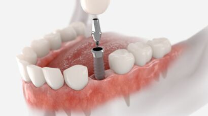 fatih implant, fatih diş implantı, fatih implant tedavisi, fatih implant diş, fatih implant fiyatları, fatih diş implant fiyatları, fındıkzade implant, fındıkzade diş implantı, fındıkzade implant tedavisi, fındıkzade implant diş, fındıkzade implant fiyatları, fındıkzade diş implant fiyatları, aksaray implant, aksaray diş implantı, aksaray implant tedavisi, aksaray implant diş, aksaray implant fiyatları, aksaray diş implant fiyatları, çapa implant, çapa diş implantı, çapa implant tedavisi, çapa implant diş, çapa implant fiyatları, çapa diş implant fiyatları, şehremini implant, şehremini diş implantı, şehremini implant tedavisi, şehremini implant diş, şehremini implant fiyatları, şehremini diş implant fiyatları, kocamustafapaşa implant, kocamustafapaşa diş implantı, kocamustafapaşa implant tedavisi, kocamustafapaşa implant diş, kocamustafapaşa implant fiyatları, kocamustafapaşa diş implant fiyatları, cerrahpaşa implant, cerrahpaşa diş implantı, cerrahpaşa implant tedavisi, cerrahpaşa implant diş, cerrahpaşa implant fiyatları, cerrahpaşa diş implant fiyatları, haseki implant, haseki diş implantı, haseki implant tedavisi, haseki implant diş, haseki implant fiyatları, haseki diş implant fiyatları, laleli implant, laleli diş implantı, laleli implant tedavisi, laleli implant diş, laleli implant fiyatları, laleli diş implant fiyatları, beyazıt implant, beyazıt diş implantı, beyazıt implant tedavisi, beyazıt implant diş, beyazıt implant fiyatları, beyazıt diş implant fiyatları, eminönü implant, eminönü diş implantı, eminönü implant tedavisi, eminönü implant diş, eminönü implant fiyatları, eminönü diş implant fiyatları, sirkeci implant, sirkeci diş implantı, sirkeci implant tedavisi, sirkeci implant diş, sirkeci implant fiyatları, sirkeci diş implant fiyatları, sultanahmet implant, sultanahmet diş implantı, sultanahmet implant tedavisi, sultanahmet implant diş, sultanahmet implant fiyatları, sultanahmet diş implant fiyatları, balat implant, balat diş implantı, balat implant tedavisi, balat implant diş, balat implant fiyatları, balat diş implant fiyatları, fener implant, fener diş implantı, fener implant tedavisi, fener implant diş, fener implant fiyatları, fener diş implant fiyatları, karagümrük implant, karagümrük diş implantı, karagümrük implant tedavisi, karagümrük implant diş, karagümrük implant fiyatları, karagümrük diş implant fiyatları, edirnekapı implant, edirnekapı diş implantı, edirnekapı implant tedavisi, edirnekapı implant diş, edirnekapı implant fiyatları, edirnekapı diş implant fiyatları, akşemsettin implant, akşemsettin diş implantı, akşemsettin implant tedavisi, akşemsettin implant diş, akşemsettin implant fiyatları, akşemsettin diş implant fiyatları, kıztaşı implant, kıztaşı diş implantı, kıztaşı implant tedavisi, kıztaşı implant diş, kıztaşı implant fiyatları, kıztaşı diş implant fiyatları, horhor implant, horhor diş implantı, horhor implant tedavisi, horhor implant diş, horhor implant fiyatları, horhor diş implant fiyatları, vezneciler implant, vezneciler diş implantı, vezneciler implant tedavisi, vezneciler implant diş, vezneciler implant fiyatları, vezneciler diş implant fiyatları, yenikapı implant, yenikapı diş implantı, yenikapı implant tedavisi, yenikapı implant diş, yenikapı implant fiyatları, yenikapı diş implant fiyatları, samatya implant, samatya diş implantı, samatya implant tedavisi, samatya implant diş, samatya implant fiyatları, samatya diş implant fiyatları, yedikule implant, yedikule diş implantı, yedikule implant tedavisi, yedikule implant diş, yedikule implant fiyatları, yedikule diş implant fiyatları, ayvansaray implant, ayvansaray diş implantı, ayvansaray implant tedavisi, ayvansaray implant diş, ayvansaray implant fiyatları, ayvansaray diş implant fiyatları