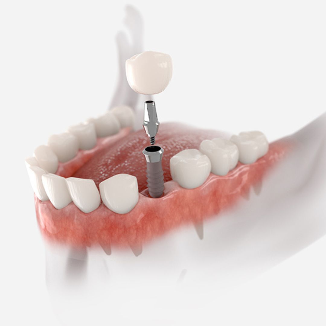 fatih implant, fatih diş implantı, fatih implant tedavisi, fatih implant diş, fatih implant fiyatları, fatih diş implant fiyatları, fındıkzade implant, fındıkzade diş implantı, fındıkzade implant tedavisi, fındıkzade implant diş, fındıkzade implant fiyatları, fındıkzade diş implant fiyatları, aksaray implant, aksaray diş implantı, aksaray implant tedavisi, aksaray implant diş, aksaray implant fiyatları, aksaray diş implant fiyatları, çapa implant, çapa diş implantı, çapa implant tedavisi, çapa implant diş, çapa implant fiyatları, çapa diş implant fiyatları, şehremini implant, şehremini diş implantı, şehremini implant tedavisi, şehremini implant diş, şehremini implant fiyatları, şehremini diş implant fiyatları, kocamustafapaşa implant, kocamustafapaşa diş implantı, kocamustafapaşa implant tedavisi, kocamustafapaşa implant diş, kocamustafapaşa implant fiyatları, kocamustafapaşa diş implant fiyatları, cerrahpaşa implant, cerrahpaşa diş implantı, cerrahpaşa implant tedavisi, cerrahpaşa implant diş, cerrahpaşa implant fiyatları, cerrahpaşa diş implant fiyatları, haseki implant, haseki diş implantı, haseki implant tedavisi, haseki implant diş, haseki implant fiyatları, haseki diş implant fiyatları, laleli implant, laleli diş implantı, laleli implant tedavisi, laleli implant diş, laleli implant fiyatları, laleli diş implant fiyatları, beyazıt implant, beyazıt diş implantı, beyazıt implant tedavisi, beyazıt implant diş, beyazıt implant fiyatları, beyazıt diş implant fiyatları, eminönü implant, eminönü diş implantı, eminönü implant tedavisi, eminönü implant diş, eminönü implant fiyatları, eminönü diş implant fiyatları, sirkeci implant, sirkeci diş implantı, sirkeci implant tedavisi, sirkeci implant diş, sirkeci implant fiyatları, sirkeci diş implant fiyatları, sultanahmet implant, sultanahmet diş implantı, sultanahmet implant tedavisi, sultanahmet implant diş, sultanahmet implant fiyatları, sultanahmet diş implant fiyatları, balat implant, balat diş implantı, balat implant tedavisi, balat implant diş, balat implant fiyatları, balat diş implant fiyatları, fener implant, fener diş implantı, fener implant tedavisi, fener implant diş, fener implant fiyatları, fener diş implant fiyatları, karagümrük implant, karagümrük diş implantı, karagümrük implant tedavisi, karagümrük implant diş, karagümrük implant fiyatları, karagümrük diş implant fiyatları, edirnekapı implant, edirnekapı diş implantı, edirnekapı implant tedavisi, edirnekapı implant diş, edirnekapı implant fiyatları, edirnekapı diş implant fiyatları, akşemsettin implant, akşemsettin diş implantı, akşemsettin implant tedavisi, akşemsettin implant diş, akşemsettin implant fiyatları, akşemsettin diş implant fiyatları, kıztaşı implant, kıztaşı diş implantı, kıztaşı implant tedavisi, kıztaşı implant diş, kıztaşı implant fiyatları, kıztaşı diş implant fiyatları, horhor implant, horhor diş implantı, horhor implant tedavisi, horhor implant diş, horhor implant fiyatları, horhor diş implant fiyatları, vezneciler implant, vezneciler diş implantı, vezneciler implant tedavisi, vezneciler implant diş, vezneciler implant fiyatları, vezneciler diş implant fiyatları, yenikapı implant, yenikapı diş implantı, yenikapı implant tedavisi, yenikapı implant diş, yenikapı implant fiyatları, yenikapı diş implant fiyatları, samatya implant, samatya diş implantı, samatya implant tedavisi, samatya implant diş, samatya implant fiyatları, samatya diş implant fiyatları, yedikule implant, yedikule diş implantı, yedikule implant tedavisi, yedikule implant diş, yedikule implant fiyatları, yedikule diş implant fiyatları, ayvansaray implant, ayvansaray diş implantı, ayvansaray implant tedavisi, ayvansaray implant diş, ayvansaray implant fiyatları, ayvansaray diş implant fiyatları