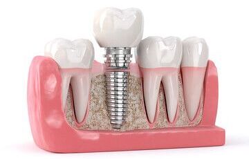 haseki implant, haseki diş implantı, haseki implant tedavisi, haseki implant diş, haseki implant fiyatları, haseki diş implant fiyatları, haseki implant yapan diş kliniği, haseki implant diş kliniği, haseki implant merkezi, haseki implant doktoru
